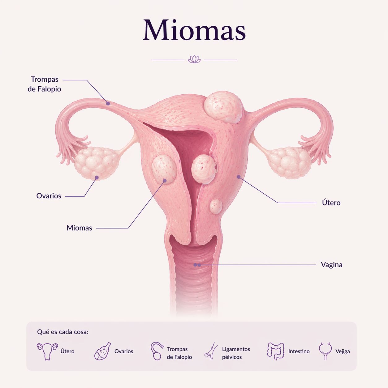 Qué es la Endometriosis miomas diagrama